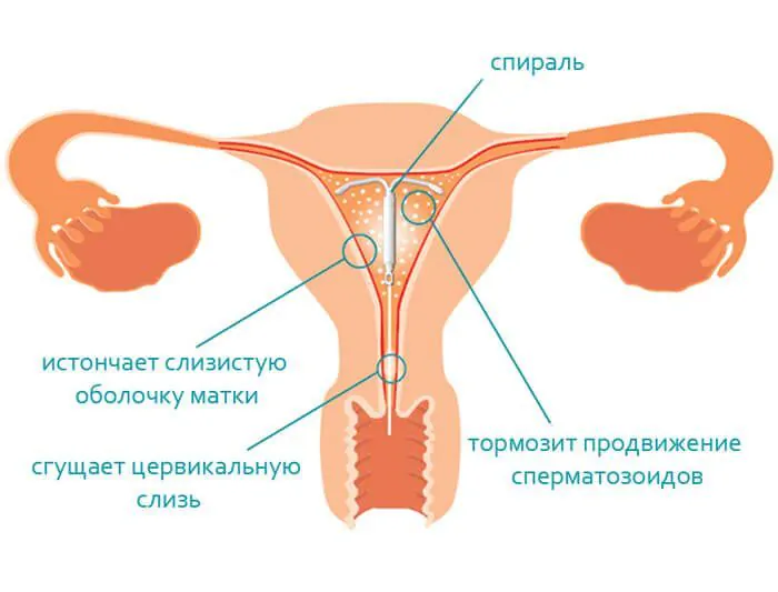 Внутриматочные спирали (ВМС)
