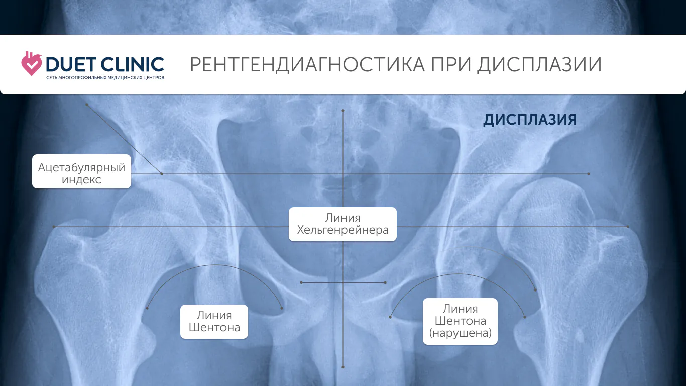 Рентгенодиагностика при дисплазии