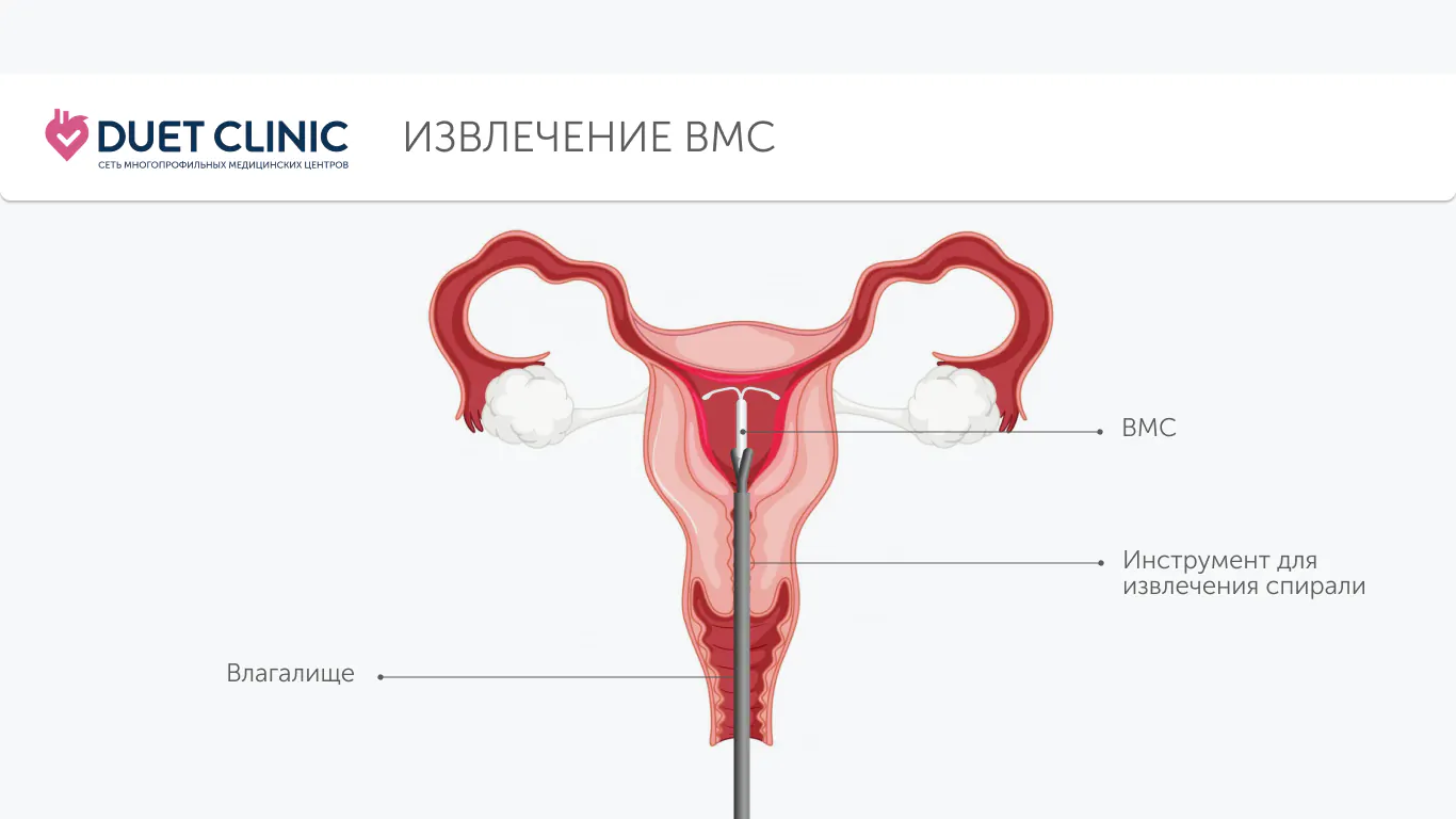 Извлечение ВМС Извлечение ВМС