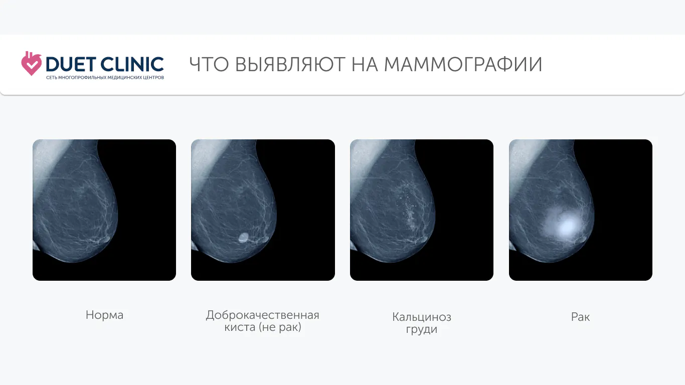 Что выявляют на маммографии