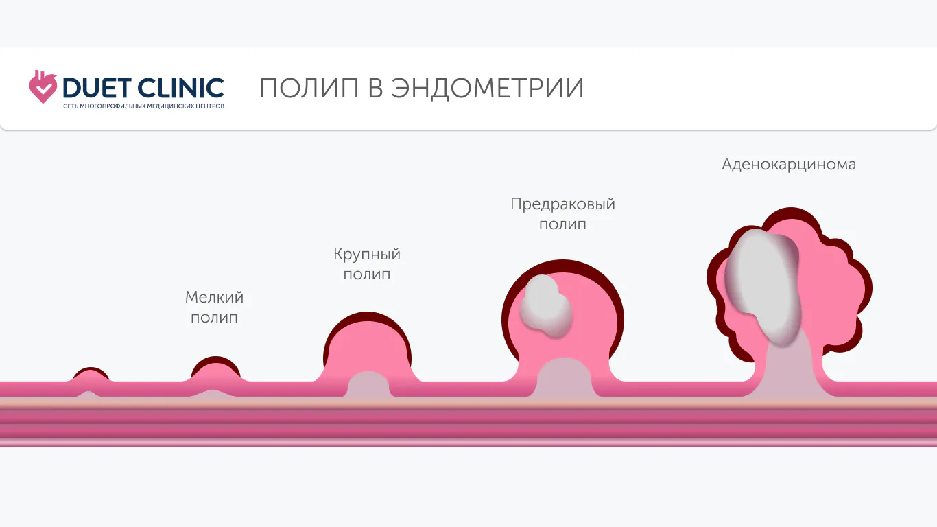 Полип в эндометрии Полип в эндометрии
