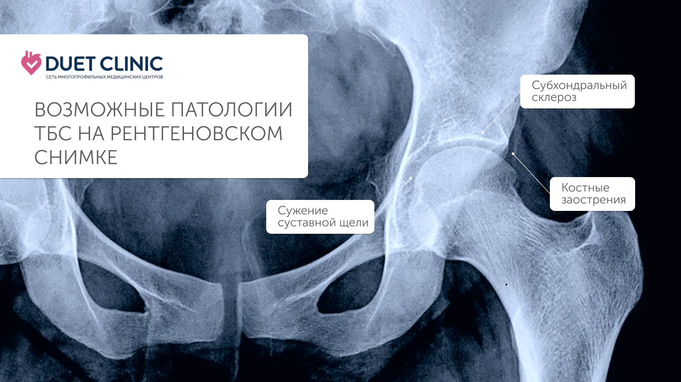 Возможные патологии ТБС на рентгеновском снимке