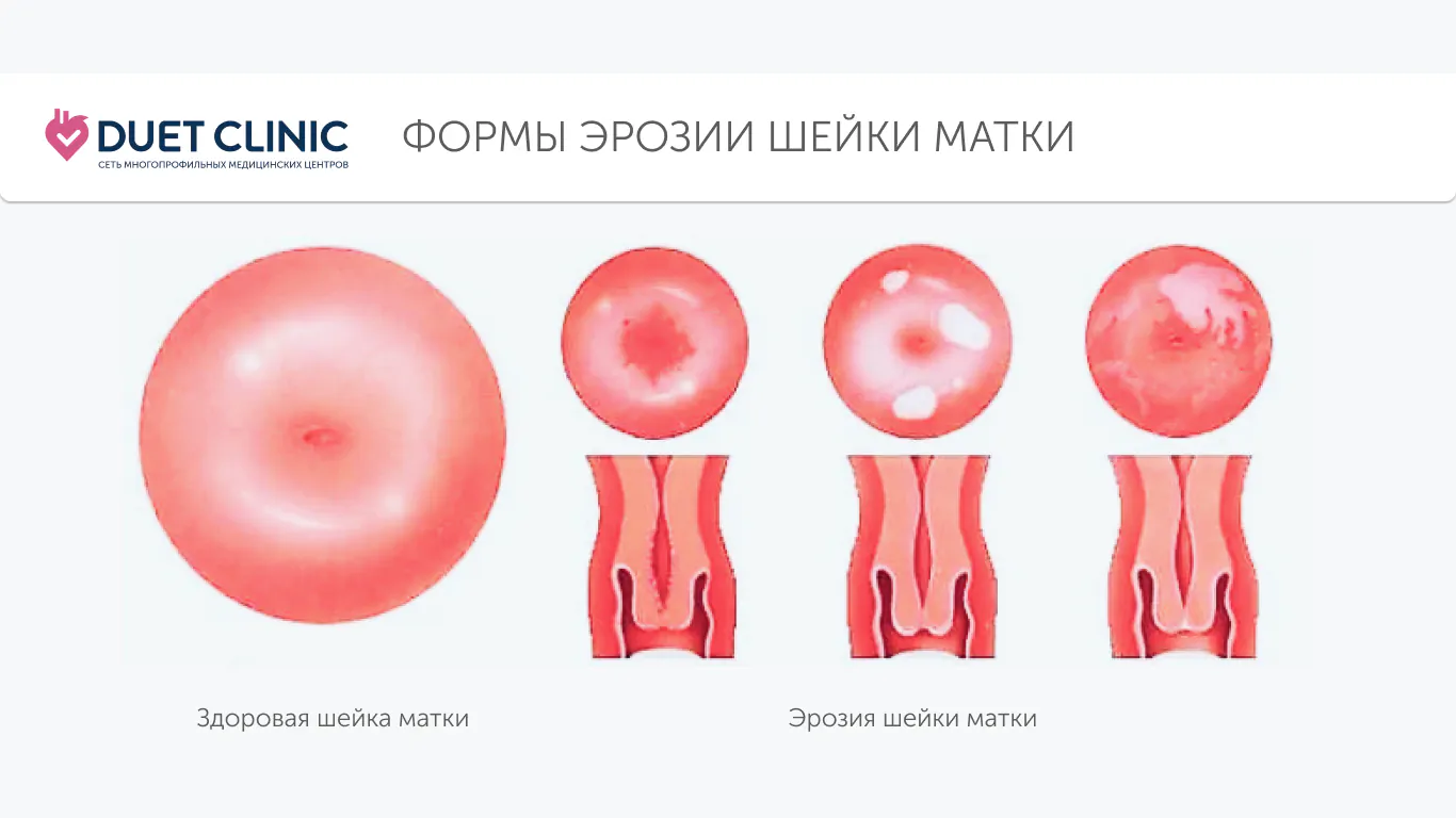 Формы эрозии шейки матки Формы эрозии шейки матки