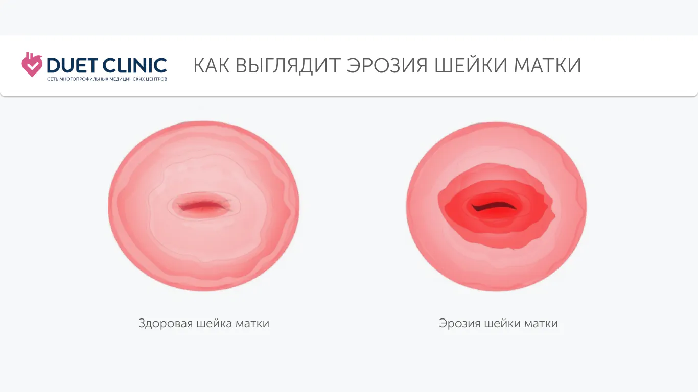 Как выглядит эрозия шейки матки Как выглядит эрозия шейки матки