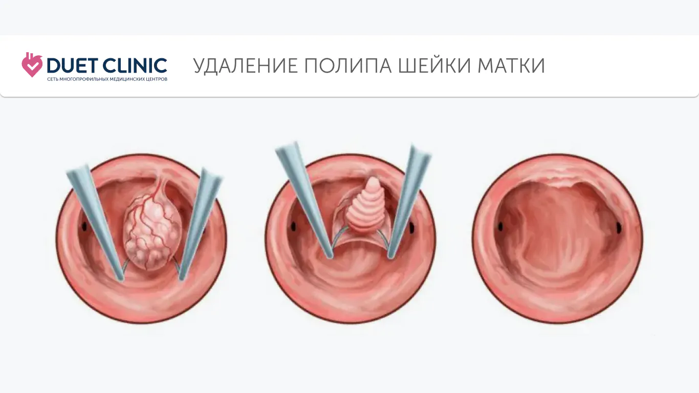 Удаление полипа при помощи гистероскопа Удаление полипа при помощи гистероскопа