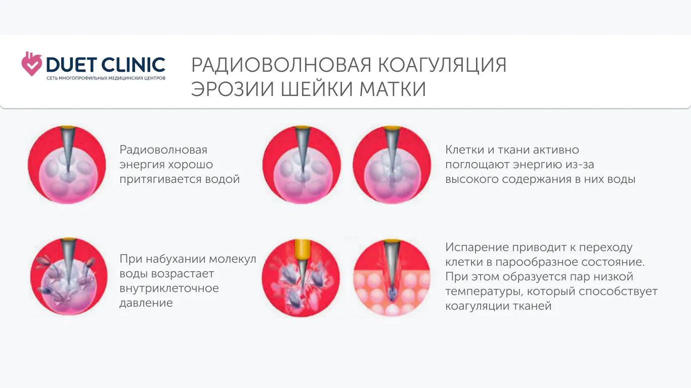 Радиоволновая коагуляция эрозии шейки матки Радиоволновая коагуляция эрозии шейки матки